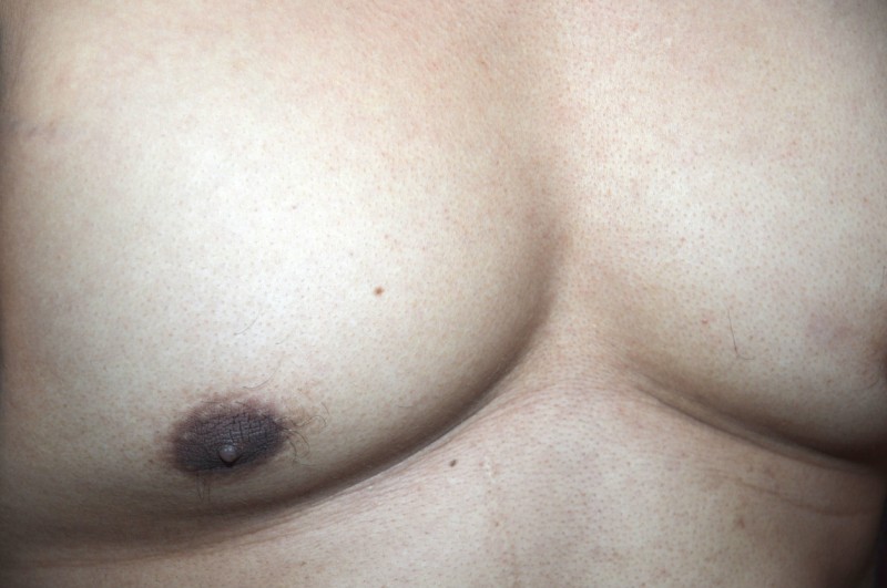 gynecomastie-adipomastie-seins-homme-800x.jpg